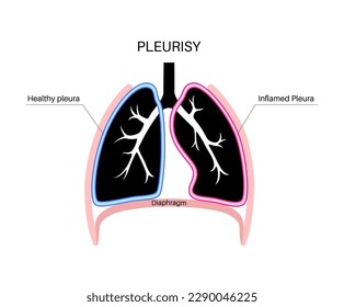 Pleurisy disease concept. Inflammation in lungs. Sharp chest pain during breathing. Unhealthy internal organs in the human body. Chest cavity problem. Respiratory system poster vector illustration.