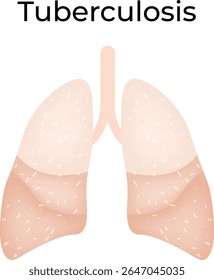 Diagrama de Ilustración vectorial de diseño de Ciencia de absceso pulmonar de pleuresía