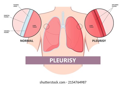 Pleurisy Lung Covid 19 Virus Lupus Pain Chest Xray Fluid Pleura Shortness Of Breath Flu Cough Sneeze Cancer COPD