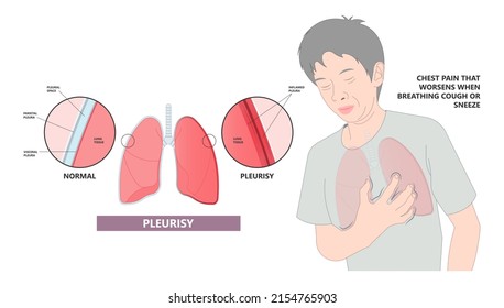 Pleurisy Lung Covid 19 Virus Lupus Pain Chest Xray Fluid Pleura Shortness Of Breath Flu Cough Sneeze Cancer COPD