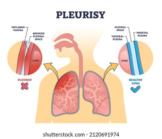 Pleurisy or pleuritis disease as medical lung inflammation outline diagram. Labeled educational scheme with healthy vs inflamed pleura difference and anatomical visceral comparison vector illustration