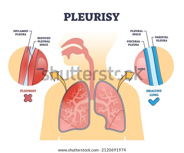 Pleurisy or pleuritis disease as medical\
lung inflammation outline diagram. Labeled educational scheme with\
healthy vs inflamed pleura difference and anatomical visceral\
comparison vector\
illustration