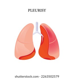 Pleurisy vector, illustration of pleurisy disease, vector design for medical
