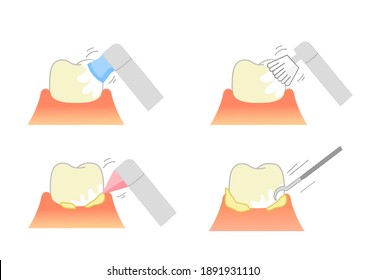 PMTC:Ilustración dental de limpieza mecánica profesional