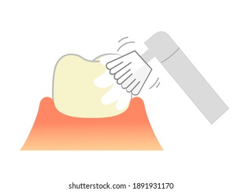 PMTC:Professional Mechanical Tooth Cleaning  Dental Illustration