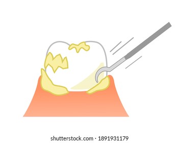 PMTC:Professional Mechanical Tooth Cleaning  Dental Illustration