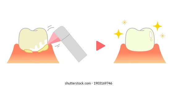 PMTC:Professional Mechanical Tooth Cleaning  Dental Illustration