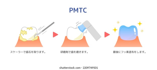 PMTC:Ilustración dental de limpieza mecánica profesional[método de traducción:PMTC]