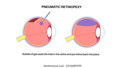 Procedimento ocular com retinopexia pneumática minimamente invasiva. Reparar o descolamento da retina. Injetar bolha de gás no vítreo para refixar a retina, combinada com laser ou ilustração de vetor de crioterapia