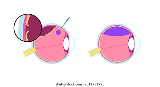 Procedimento ocular com retinopexia pneumática minimamente invasiva. Reparar o descolamento da retina. Injetar bolha de gás no vítreo para refixar a retina, combinada com laser ou ilustração de vetor de crioterapia