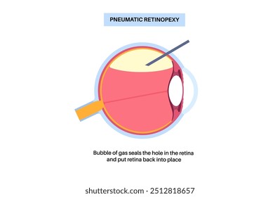 Procedimento ocular com retinopexia pneumática minimamente invasiva. Reparar o descolamento da retina. Injetar bolha de gás no vítreo para refixar a retina, combinada com laser ou ilustração de vetor de crioterapia