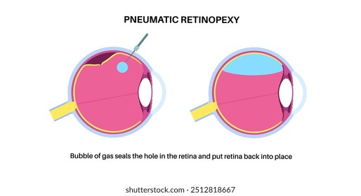 Procedimento ocular com retinopexia pneumática minimamente invasiva. Reparar o descolamento da retina. Injetar bolha de gás no vítreo para refixar a retina, combinada com laser ou ilustração de vetor de crioterapia