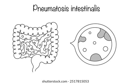 Pneumatosis intestinalis. A disease in which gas-filled cysts form in the walls of the lower digestive system. Drawn intestine with cysts and gas. Black and white line illustration.