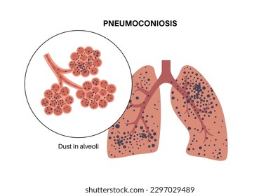 Pneumoconiosis, asbestosis and silicosis. Coal workers disease, CWP or black lung occupational illness, coal mine dust or asbestos in the respiratory system. Shortness of breath, chest pain vector