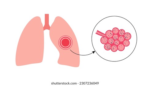 Pneumoconiosis, asbestosis and silicosis. Coal workers disease, CWP or black lung occupational illness, coal mine dust or asbestos in the respiratory system. Shortness of breath, chest pain vector