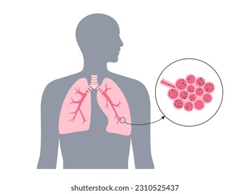 Neumoconiosis, asbestosis y silicosis. Enfermedad de los trabajadores del carbón, enfermedad laboral por PCA o enfermedad del pulmón negro, polvo de minas de carbón o amianto en el sistema respiratorio. Escasez de aliento, vectores de dolor torácico