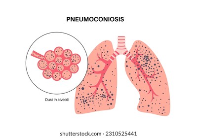 Pneumokoniose, Asbest und Silikose. Berufskrankheit der Kohlearbeiter, CWP oder schwarze Lungenkrankheit, Kohlebergstaub oder Asbest im Atemsystem. Kurzatmigkeit, Brustschmerz, Vektorgrafik