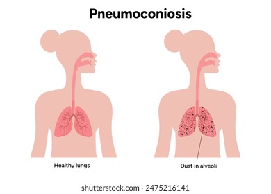 Pneumoconiosis, healthy and black in human lungs 