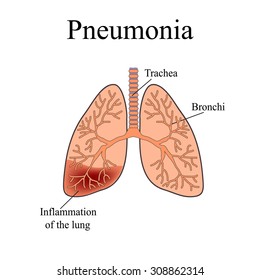 Pneumonia. The anatomical structure of the human lung. Vector illustration on isolated background.