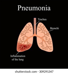 Pneumonia Anatomical Structure Human Lung Vector Stock Vector (Royalty ...