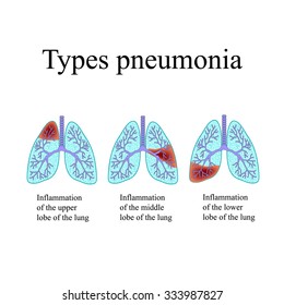 Pneumonia. The anatomical structure of the human lung. Type of pneumonia. Vector illustration on isolated background.
