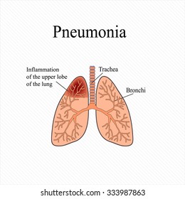 Pneumonia Anatomical Structure Human Lung Inflammation Stock Vector ...