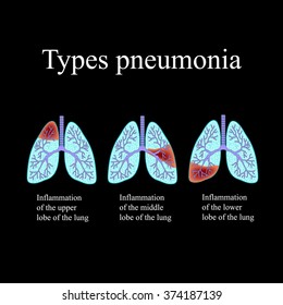 Pneumonia. The anatomical structure of the human lung. Type of pneumonia. Vector illustration on a black background.