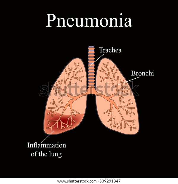 Pneumonia Anatomical Structure Human Lung Vector 스톡 벡터(로열티 프리 ...