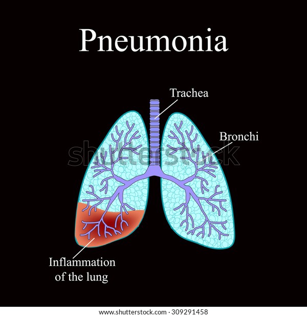 Diagram Showing Lung With Pneumonia Royalty Free Vector 9dd