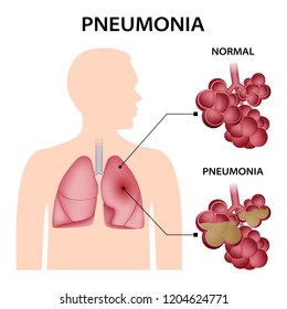 Pneumonia concept background. Realistic illustration of pneumonia vector concept background for web design