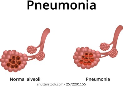 Pneumonia Design Science Vector Illustration