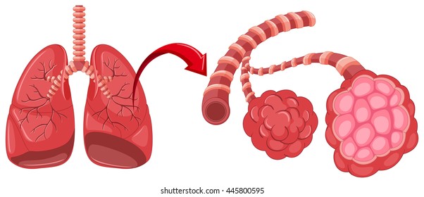 Human Lung Pneumonia Illustration Stock Vector (Royalty Free) 449851129