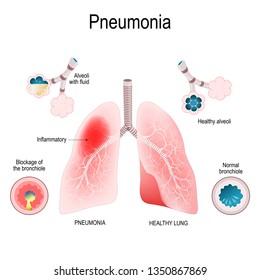 Neumonía. Diferencia y Comparación de pulmones sanos (bronquioles y alveoli) y pulmones con neumonía. sistema respiratorio humano. set Ilustración vectorial para uso médico y científico