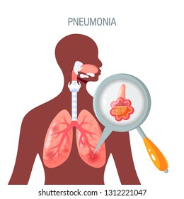 Pneumonia disease concept. Vector illustration in flat style for medical atlases, articles, infographics etc.