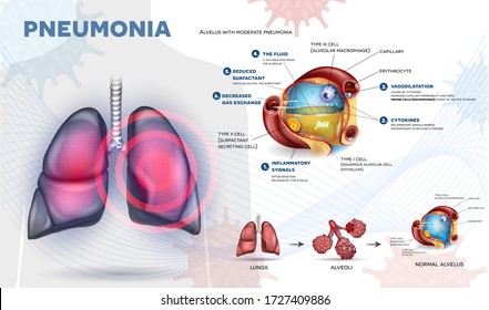 Pneumonia explained info poster, body immune response, human lungs and detailed alveolus anatomy illustration
