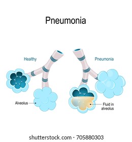 Pneumonia. Healthy alveoli and alveolus with pneumonia. Illustration shows normal and infected alveoli.