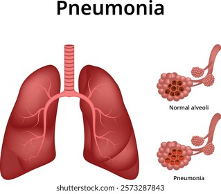 Pneumonia Healthy vs Infected Lungs Pneumonia Normal Alveoli Lung Vector Illustration Science