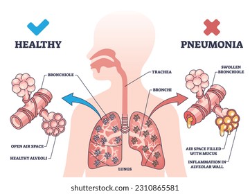 Pneumonia illness medical comparison with healthy lungs outline diagram. Respiratory system problem with bronchi wall inflammation and air filled with mucus vector illustration. Bacterial infection.