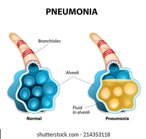 Pneumonia. Illustration shows normal and infected alveoli.