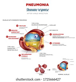 Pneumonia immune response step by step after virus infection, detailed alveolus anatomy illustration