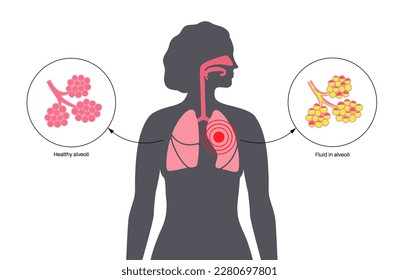 Pneumonia infection anatomical poster. Inflammation in the human respiratory system. Alveoli with fluid. Disease in lungs, purulent material in chest. Difficult breathing and cough vector illustration