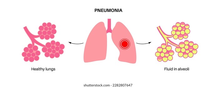 Afiche anatómico de infección por neumonía. Inflamación en el sistema respiratorio humano. Alveoli con fluido. Enfermedad en pulmones, material púrpura en el pecho. Difícil respiración e ilustración del vector de tos