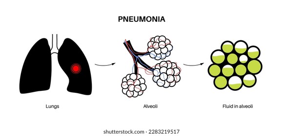 Pneumonia infection anatomical poster. Inflammation in the human respiratory system. Alveoli with fluid. Disease in lungs, purulent material in chest. Difficult breathing and cough vector illustration