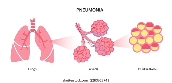 Afiche anatómico de infección por neumonía. Inflamación en el sistema respiratorio humano. Alveoli con fluido. Enfermedad en pulmones, material púrpura en el pecho. Difícil respiración e ilustración del vector de tos