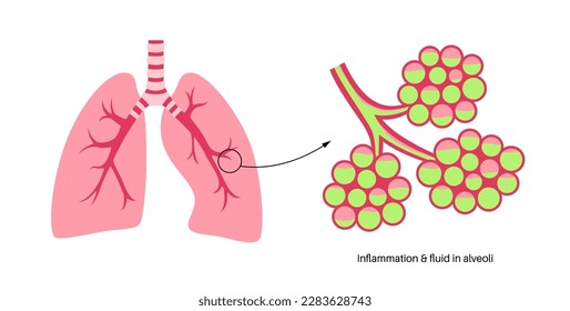 Pneumonia infection anatomical poster. Inflammation in the human respiratory system. Alveoli with fluid. Disease in lungs, purulent material in chest. Difficult breathing and cough vector illustration