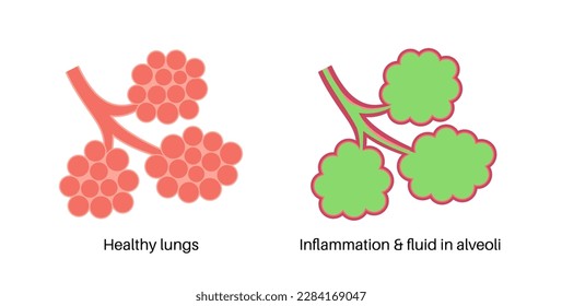 Pneumonia infection anatomical poster. Inflammation in the human respiratory system. Alveoli with fluid. Disease in lungs, purulent material in chest. Difficult breathing and cough vector illustration