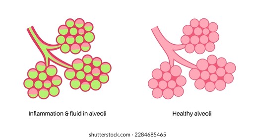 Pneumonia infection anatomical poster. Inflammation in the human respiratory system. Alveoli with fluid. Disease in lungs, purulent material in chest. Difficult breathing and cough vector illustration