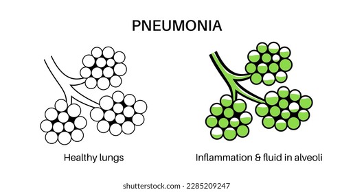 Pneumonia infection anatomical poster. Inflammation in the human respiratory system. Alveoli with fluid. Disease in lungs, purulent material in chest. Difficult breathing and cough vector illustration