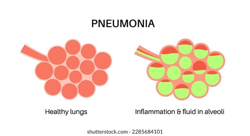 Afiche anatómico de infección por neumonía. Inflamación en el sistema respiratorio humano. Alveoli con fluido. Enfermedad en pulmones, material púrpura en el pecho. Difícil respiración e ilustración del vector de tos