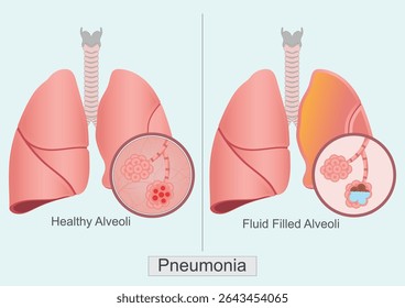 Pneumonia is an infection that inflames the air sacs in lungs.It can be caused by bacteria, viruses, or fungi.Medical health care, vector illustration.  